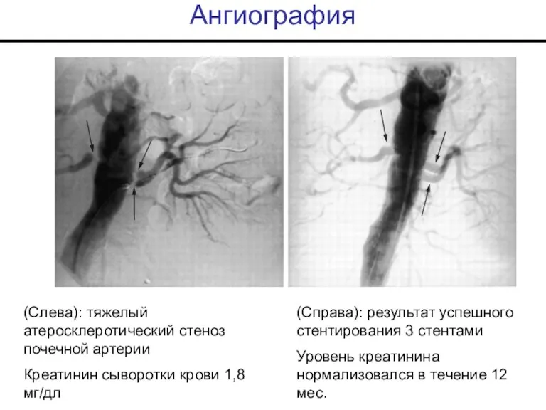 Ангиография (Слева): тяжелый атеросклеротический стеноз почечной артерии Креатинин сыворотки крови