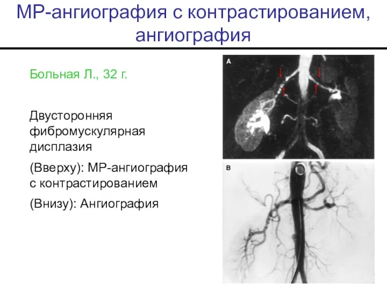 МР-ангиография с контрастированием, ангиография Больная Л., 32 г. Двусторонняя фибромускулярная