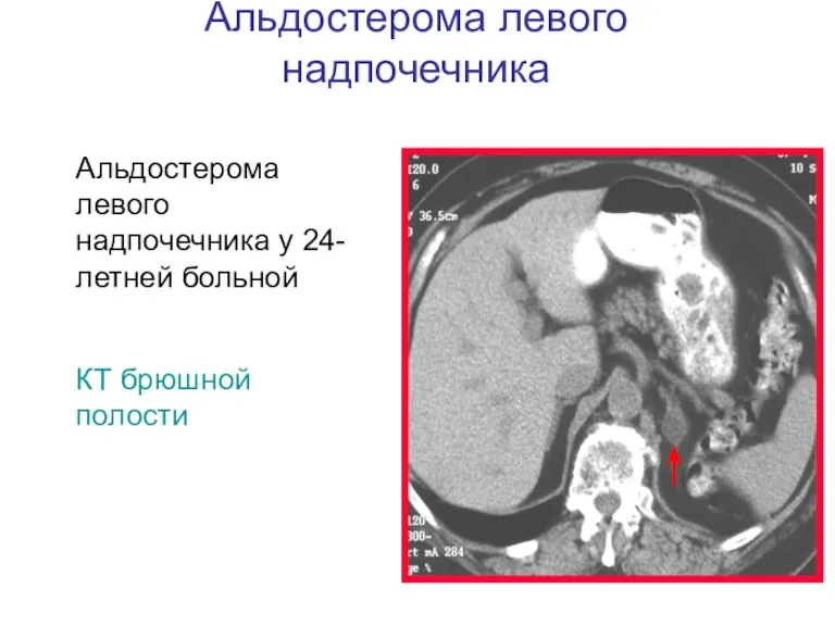 Альдостерома левого надпочечника Альдостерома левого надпочечника у 24-летней больной КТ брюшной полости