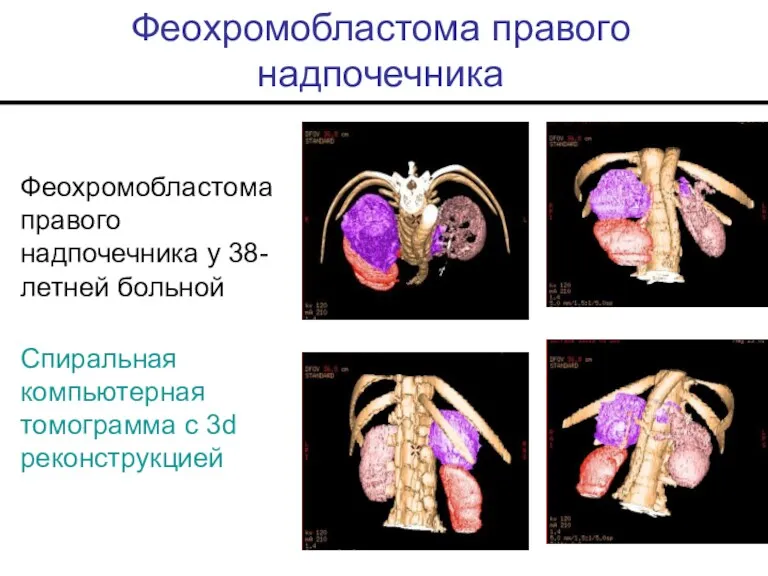 Феохромобластома правого надпочечника Феохромобластома правого надпочечника у 38-летней больной Спиральная компьютерная томограмма с 3d реконструкцией