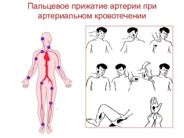 Пальцевое прижатие артерии при артериальном кровотечении