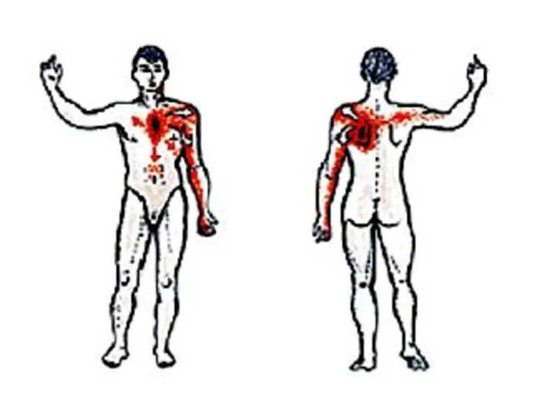 Клиническая картина: Характер болевого синдрома в грудной клетке: дискомфорт или