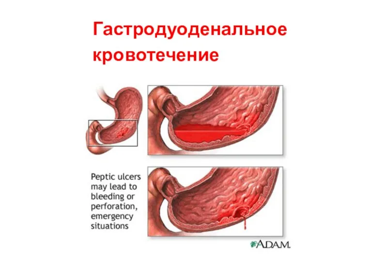 Гастродуоденальное кровотечение