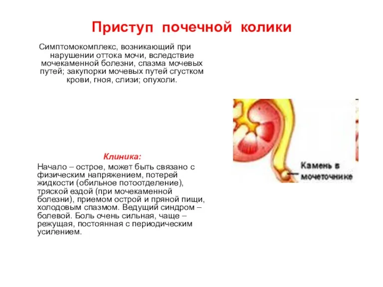 Приступ почечной колики Симптомокомплекс, возникающий при нарушении оттока мочи, вследствие