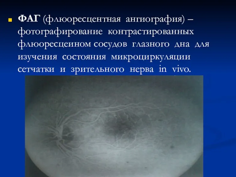 ФАГ (флюоресцентная ангиография) – фотографирование контрастированных флюоресцеином сосудов глазного дна для изучения состояния