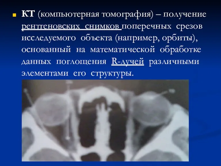 КТ (компьютерная томография) – получение рентгеновских снимков поперечных срезов исследуемого объекта (например, орбиты),