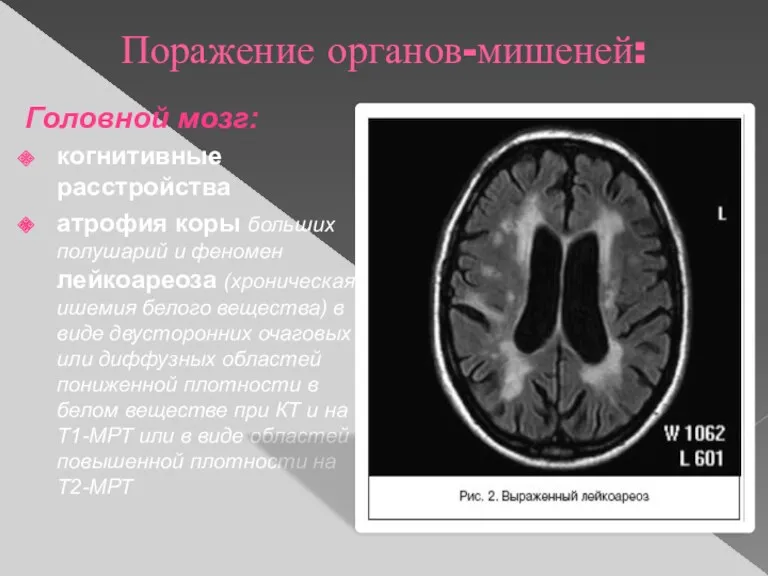 Поражение органов-мишеней: Головной мозг: когнитивные расстройства атрофия коры больших полушарий