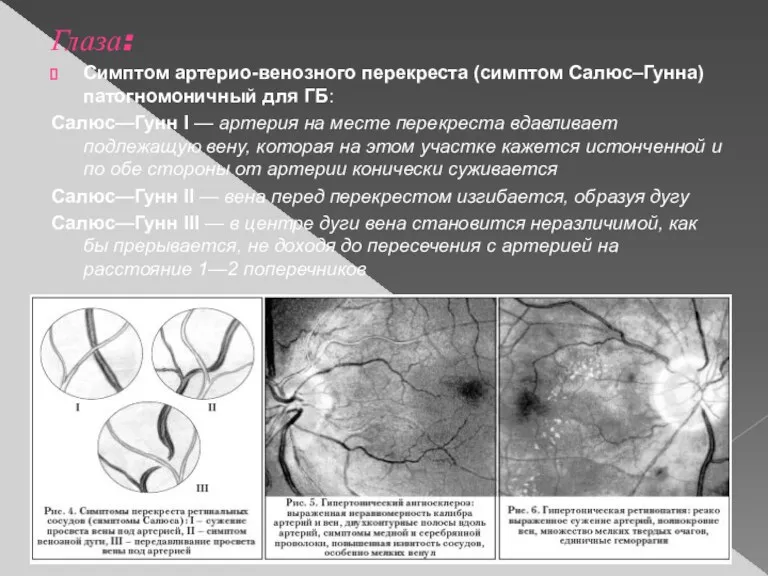 Глаза: Симптом артерио-венозного перекреста (симптом Салюс–Гунна) патогномоничный для ГБ: Салюс—Гунн