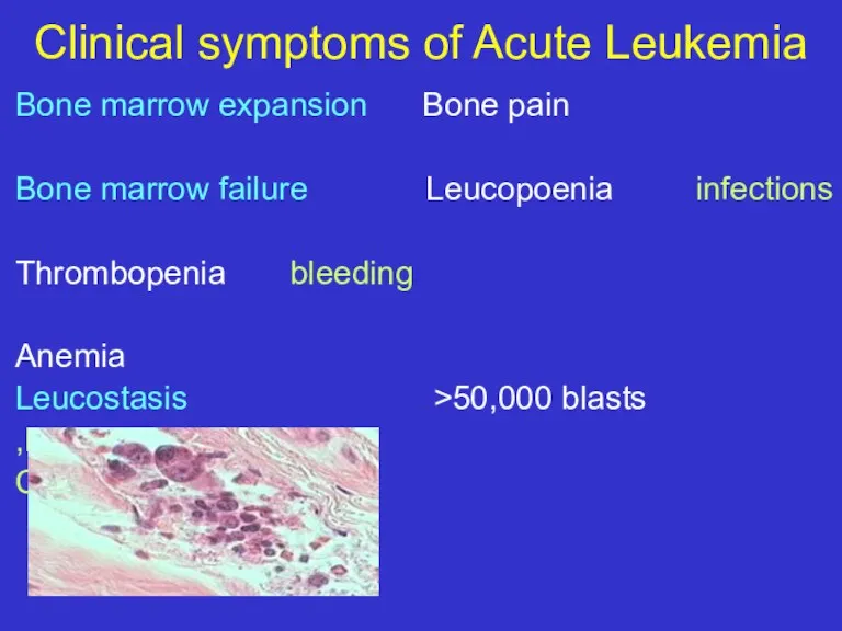 Clinical symptoms of Acute Leukemia Bone marrow expansion Bone pain Bone marrow failure