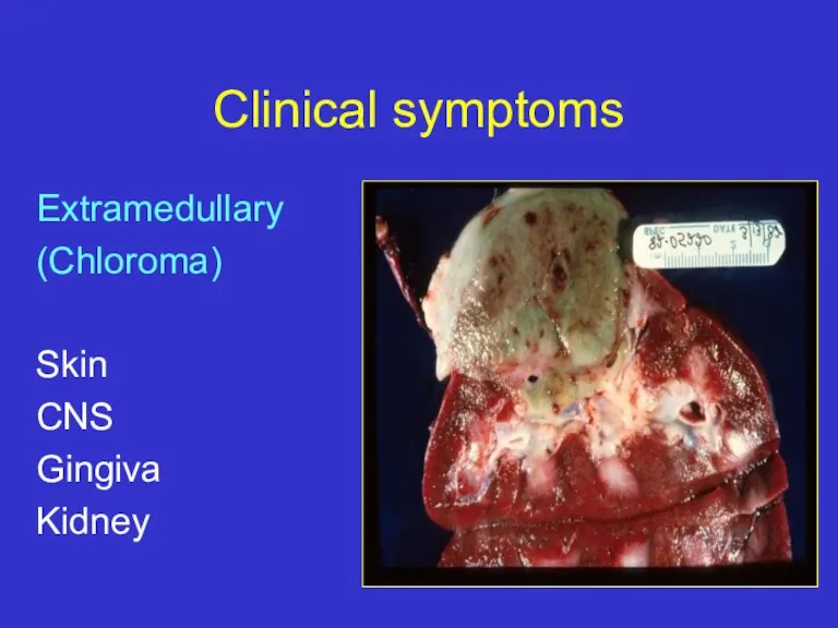 Clinical symptoms Extramedullary (Chloroma) Skin CNS Gingiva Kidney
