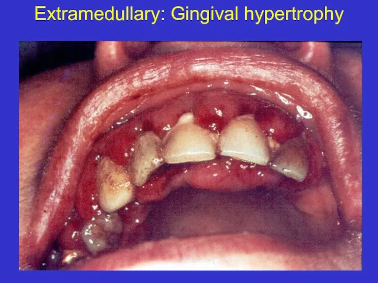 Extramedullary: Gingival hypertrophy