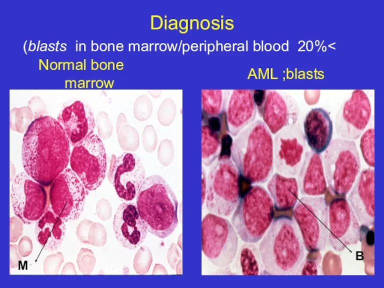 Diagnosis >20% blasts in bone marrow/peripheral blood) AML ;blasts B M Normal bone marrow