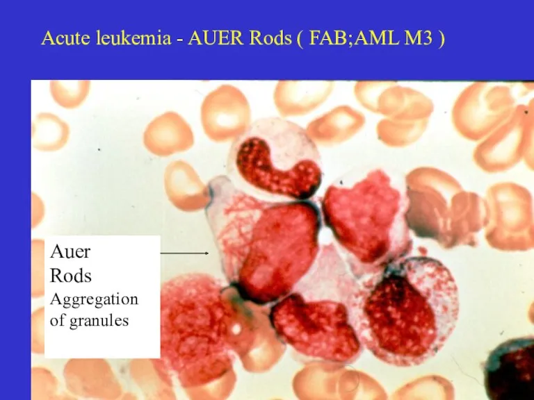 Acute leukemia - AUER Rods ( FAB;AML M3 ) Auer Rods Aggregation of granules