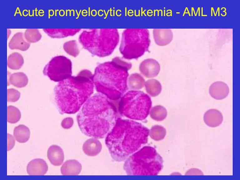 Acute promyelocytic leukemia - AML M3
