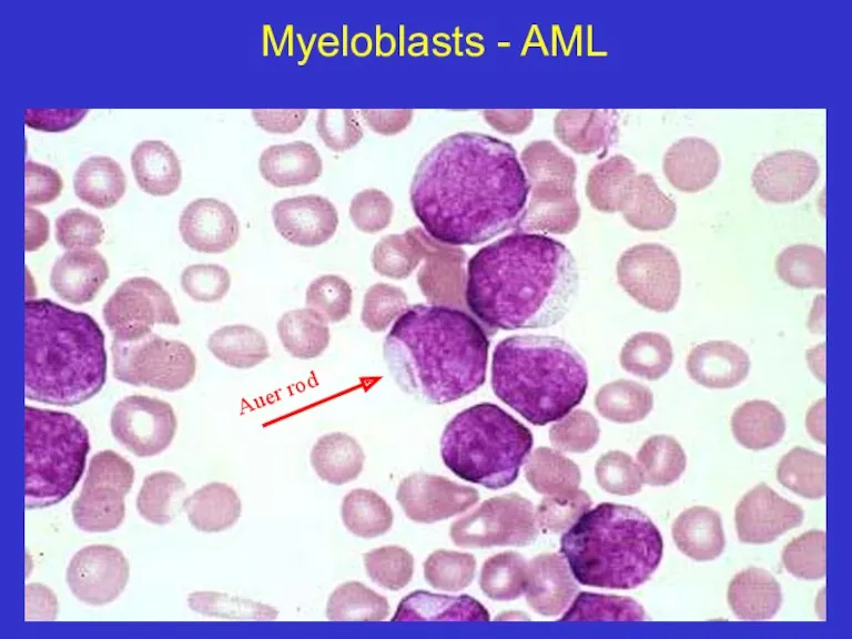 Myeloblasts - AML Auer rod