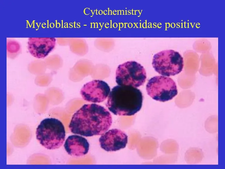Cytochemistry Myeloblasts - myeloproxidase positive