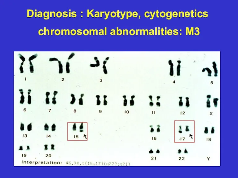 Diagnosis : Karyotype, cytogenetics chromosomal abnormalities: M3