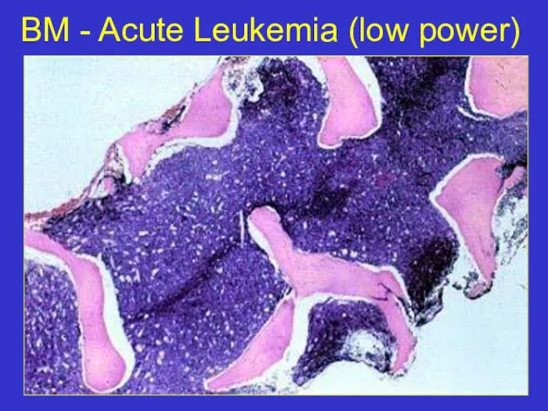 BM - Acute Leukemia (low power)