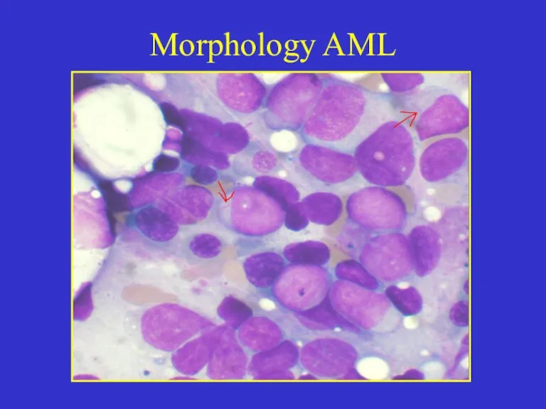 Morphology AML