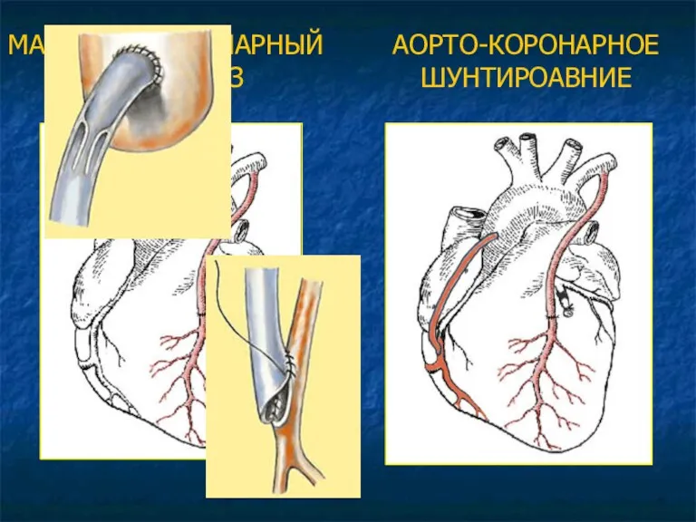 МАММАРО-КОРОНАРНЫЙ АНАСТОМОЗ АОРТО-КОРОНАРНОЕ ШУНТИРОАВНИЕ