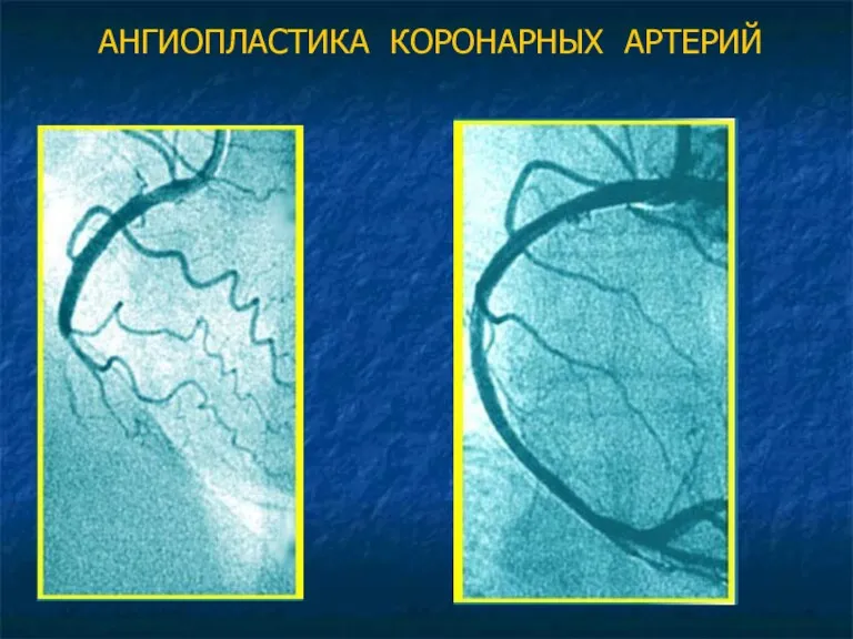 АНГИОПЛАСТИКА КОРОНАРНЫХ АРТЕРИЙ