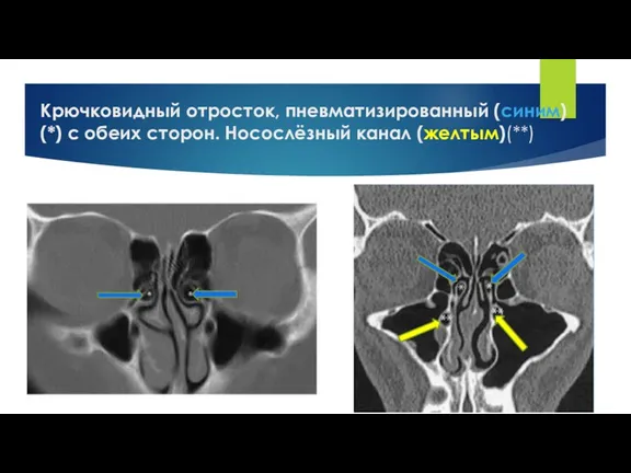 Крючковидный отросток, пневматизированный (синим) (*) с обеих сторон. Носослёзный канал (желтым)(**)