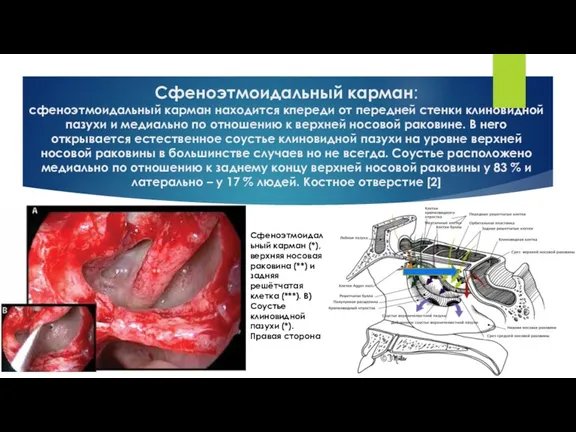 Сфеноэтмоидальный карман: сфеноэтмоидальный карман находится кпереди от передней стенки клиновидной