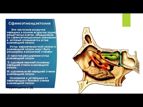 Сфеноэтмоидэктомия Это частичное вскрытие передних и полное вскрытие задних решетчатых