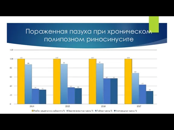 Пораженная пазуха при хроническом полипозном риносинусите