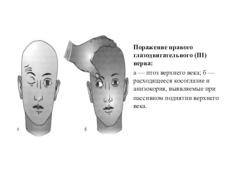 Поражение правого глазодвигательного (III) нерва: а — птоз верхнего века;