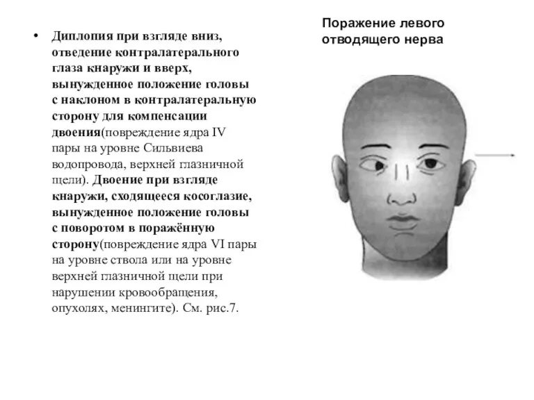 Диплопия при взгляде вниз, отведение контралатерального глаза кнаружи и вверх,