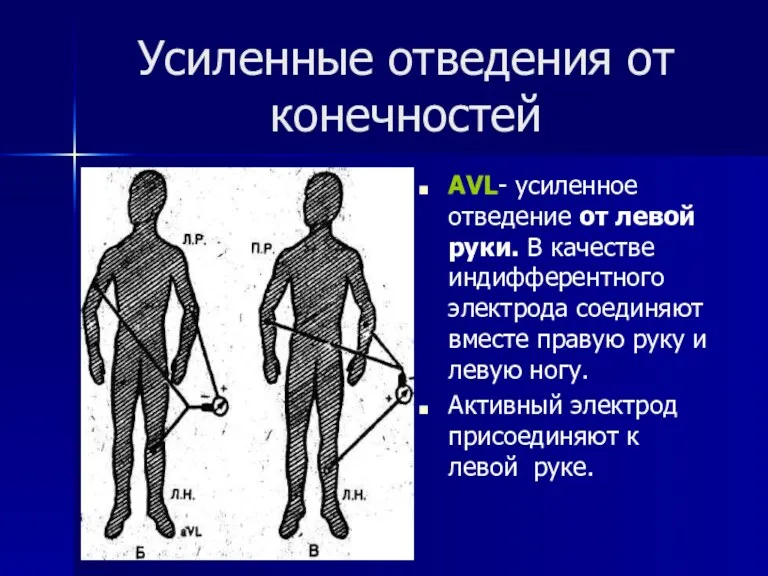 Усиленные отведения от конечностей АVL- усиленное отведение от левой руки.