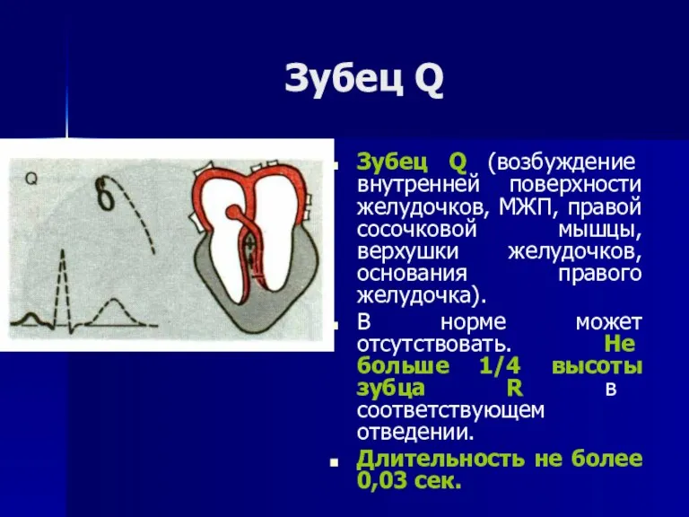 Зубец Q Зубец Q (возбуждение внутренней поверхности желудочков, МЖП, правой