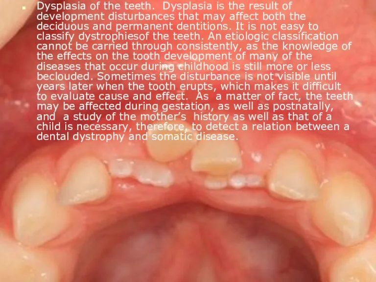 Dysplasia of the teeth. Dysplasia is the result of development