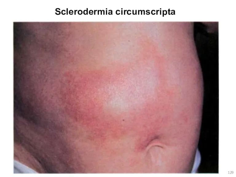Sclerodermia circumscripta
