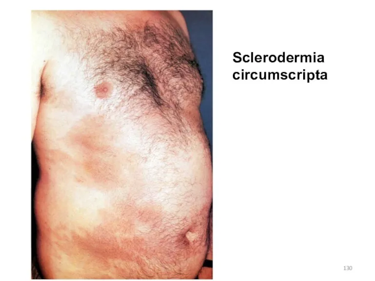 Sclerodermia circumscripta