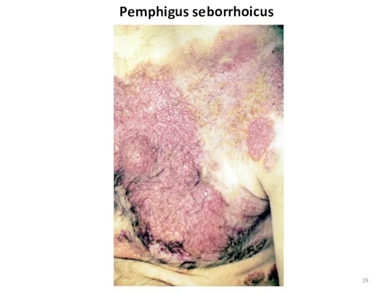 Pemphigus seborrhoicus