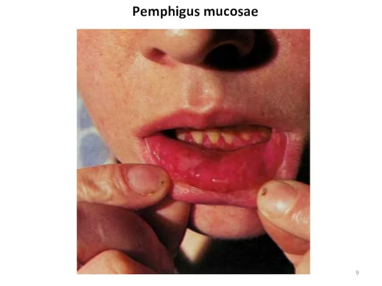 Pemphigus mucosae