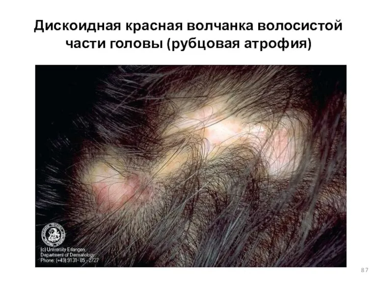 Дискоидная красная волчанка волосистой части головы (рубцовая атрофия)