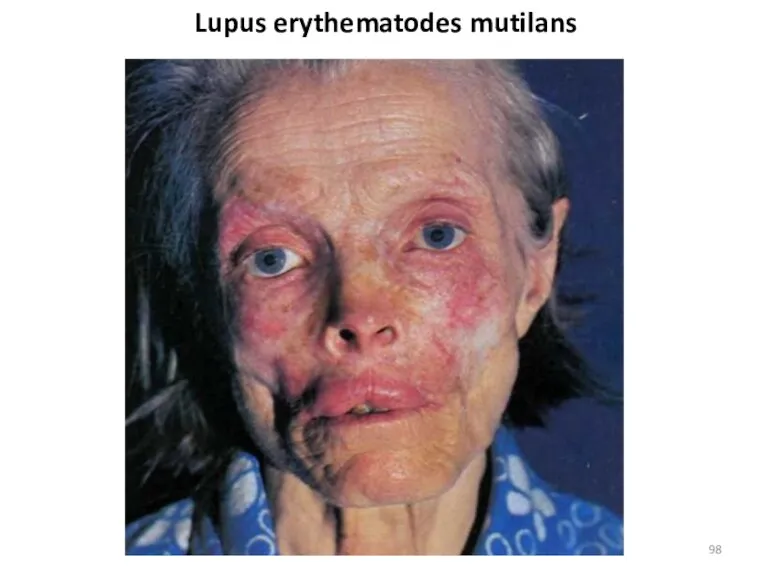 Lupus erythematodes mutilans