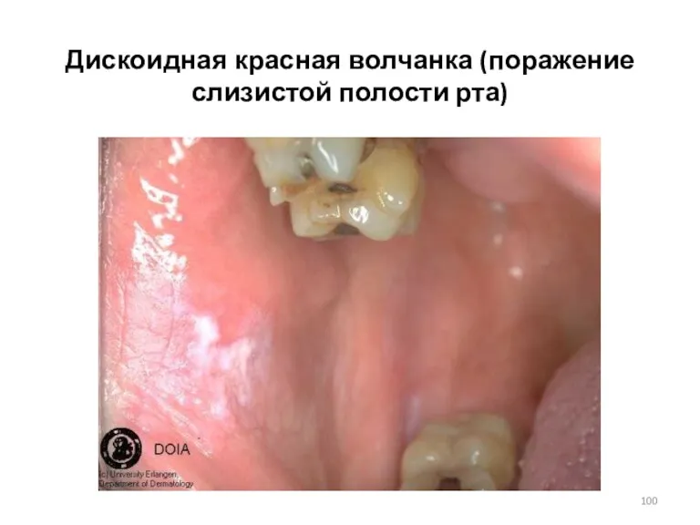 Дискоидная красная волчанка (поражение слизистой полости рта)