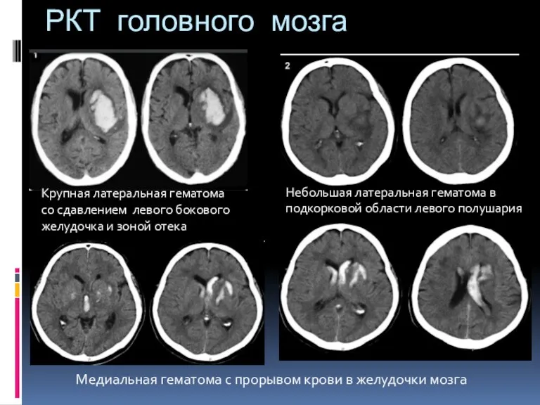 РКТ головного мозга Небольшая латеральная гематома в подкорковой области левого