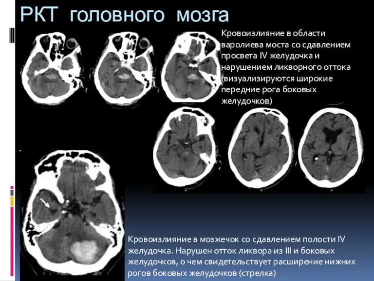 РКТ головного мозга Кровоизлияние в области варолиева моста со сдавлением