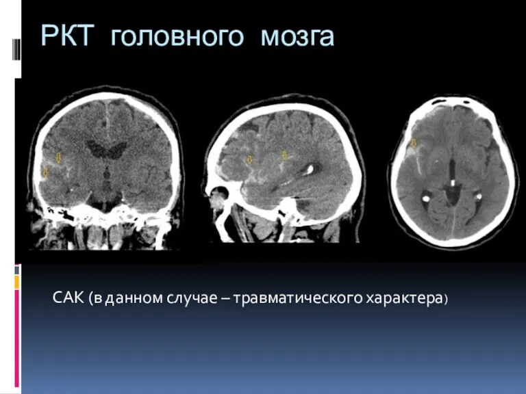 РКТ головного мозга САК (в данном случае – травматического характера)