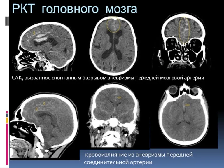 РКТ головного мозга САК, вызванное спонтанным разрывом аневризмы передней мозговой