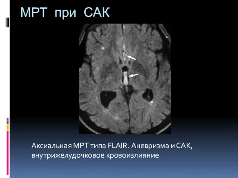 МРТ при САК Аксиальная МРТ типа FLAIR. Аневризма и САК, внутрижелудочковое кровоизлияние