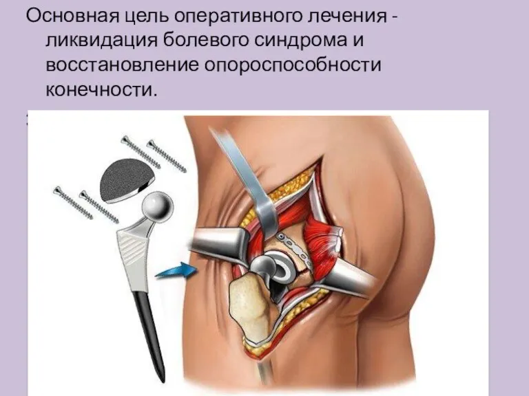 Основная цель оперативного лечения - ликвидация болевого синдрома и восстановление опороспособности конечности. Эндопротезирование суставов