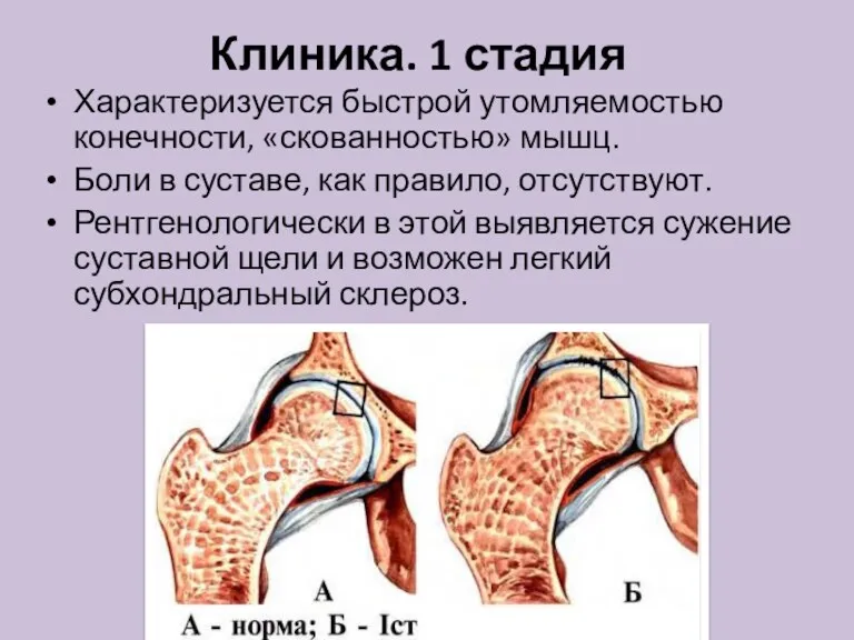 Клиника. 1 стадия Характеризуется быстрой утомляемостью конечности, «скованностью» мышц. Боли