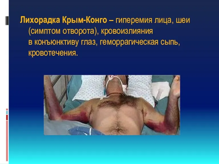Лихорадка Крым-Конго – гиперемия лица, шеи (симптом отворота), кровоизлияния в конъюнктиву глаз, геморрагическая сыпь, кровотечения.