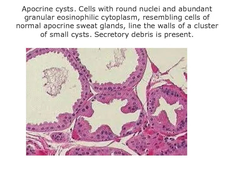 Apocrine cysts. Cells with round nuclei and abundant granular eosinophilic cytoplasm, resembling cells